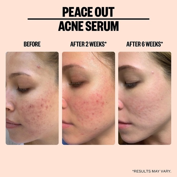 Set peace out solution acne - Picture 4 of 4